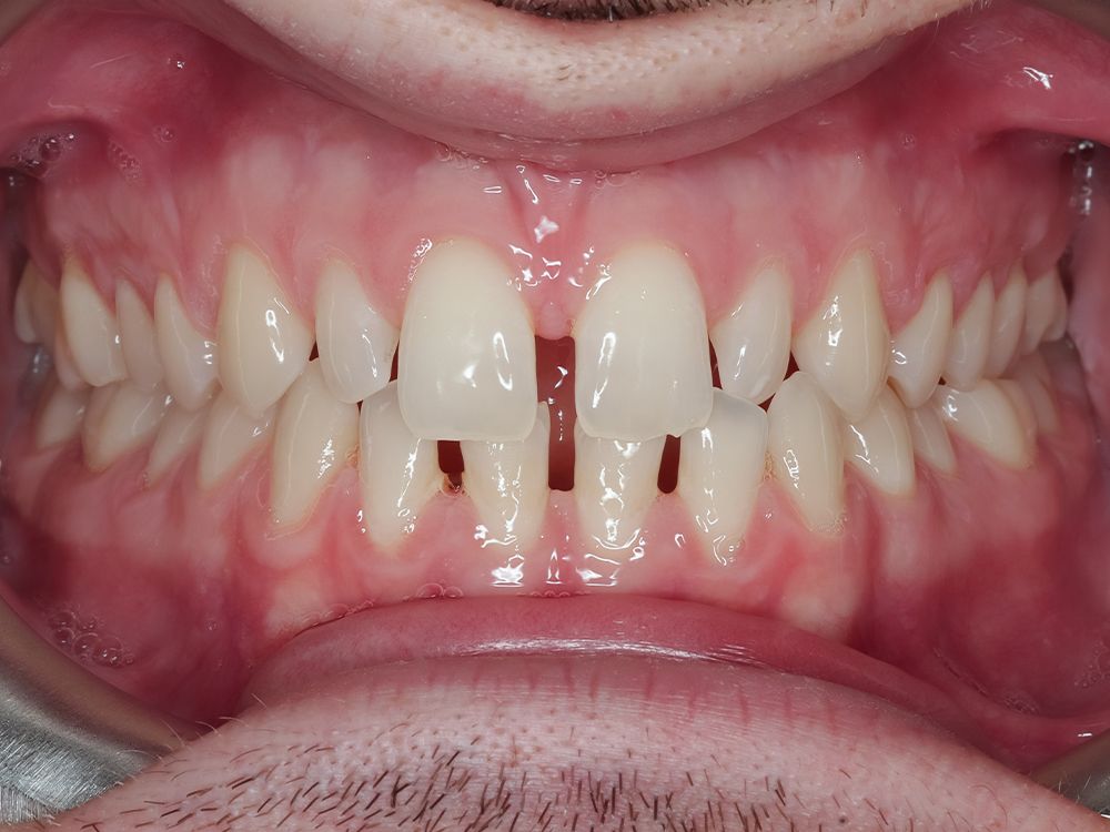 diastema - 3Dental
